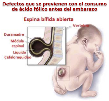 Espina Bífida Abierta Espina Bífida Abierta